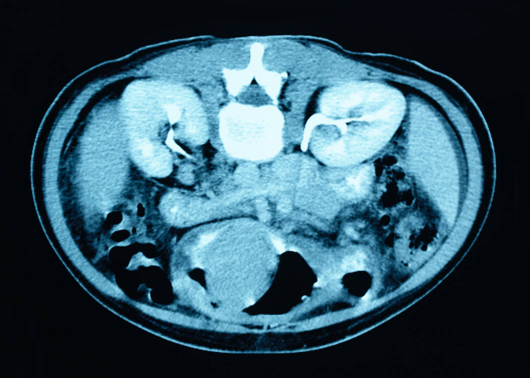 bladder_cat_scan.jpg